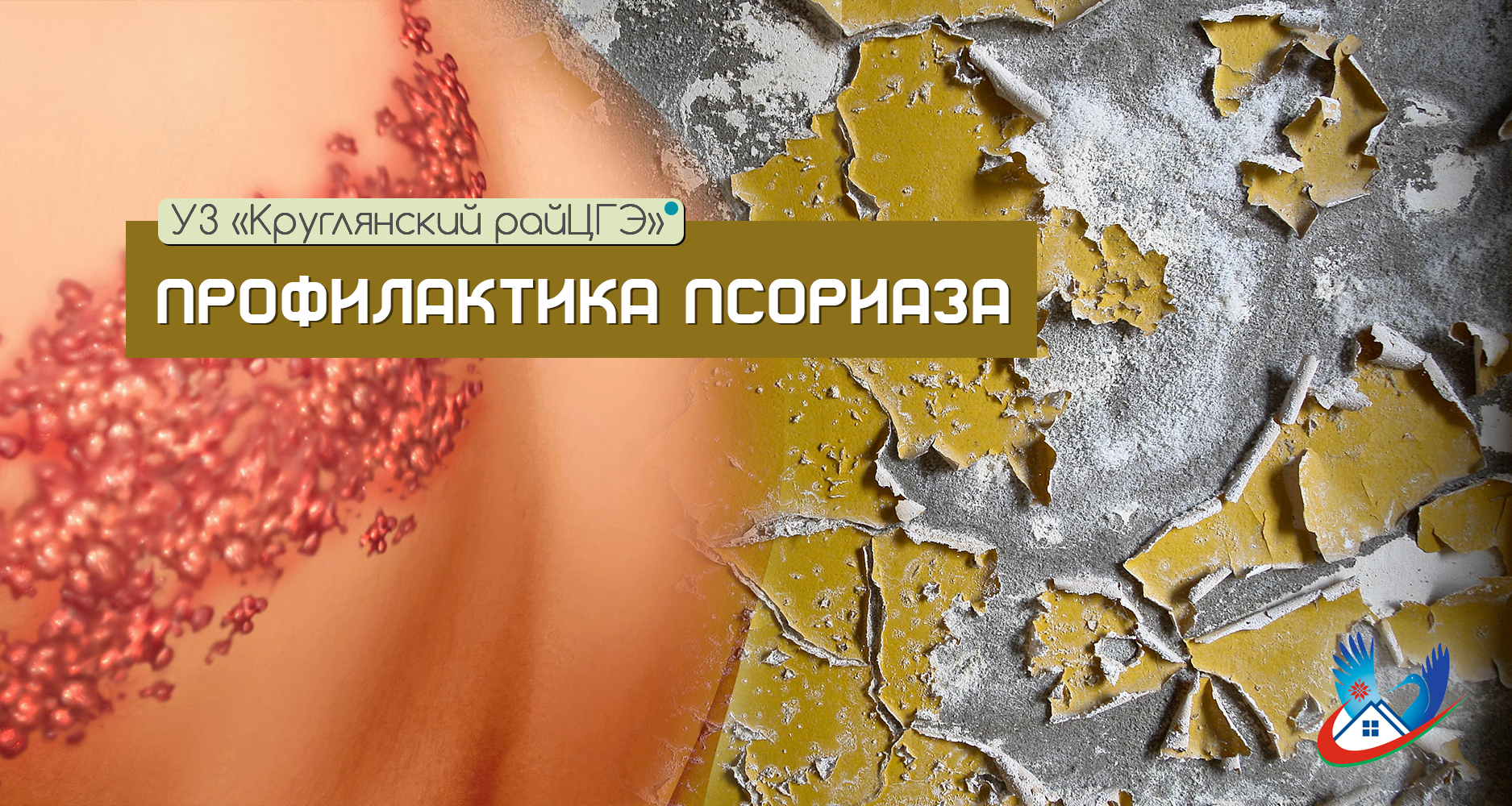 Профилактика псориаза