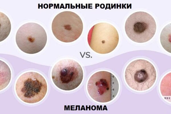 Меланома: лечение и диагностика