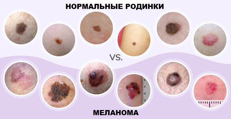 Меланома: лечение и диагностика